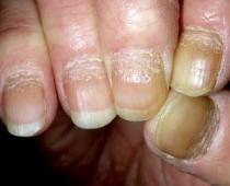 Elenco dei rimedi più efficaci per il trattamento della psoriasi ungueale Cambiamenti nelle unghie con psoriasi